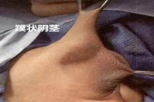 呼和浩特男人睾丸包皮是怎么回事(内蒙古呼和浩特的男人好吗)