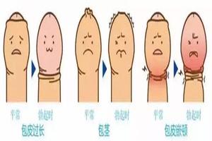 呼和浩特有多少人有包皮(呼和浩特第一医院男科怎么样)