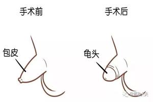 呼和浩特治包皮(包头男性科哪家医院好)