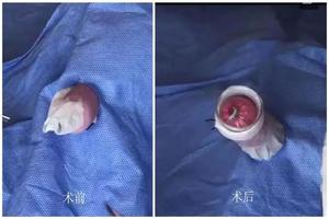 呼和浩特男孩割包皮最佳年龄(呼和浩特包茎手术)