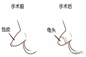 呼和浩特男友包皮口小(呼和浩特男士割包皮大概多少钱)