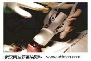 呼和浩特微创切包皮龟头很黑(微创切割包皮)