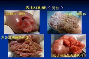 呼和浩特男性尿道外口处的包皮有小水泡(男性尿道口起泡是什么原因)